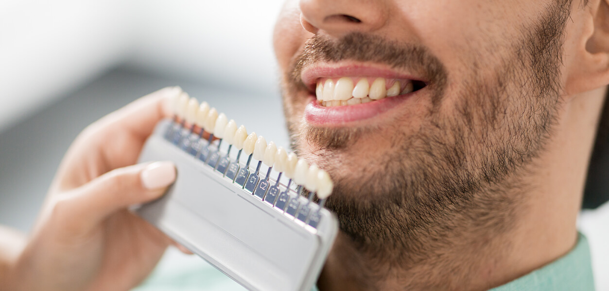 Veneers