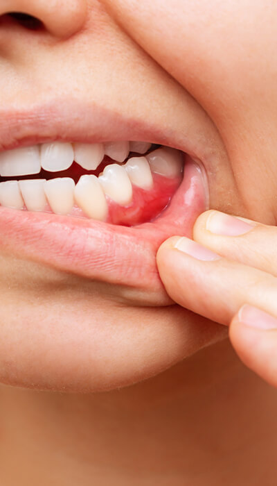 Parodontalbehandlung