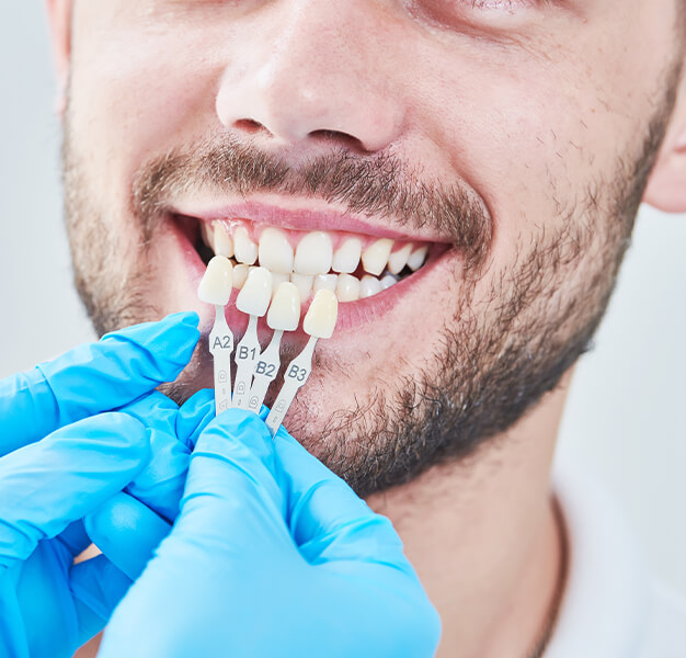 Veneers